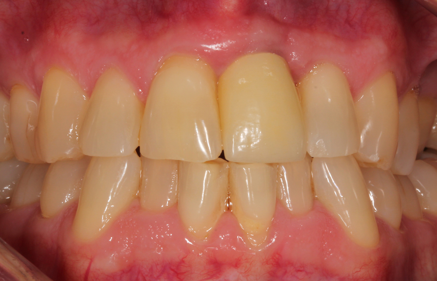 after dental implant #9, Shawnee, OK