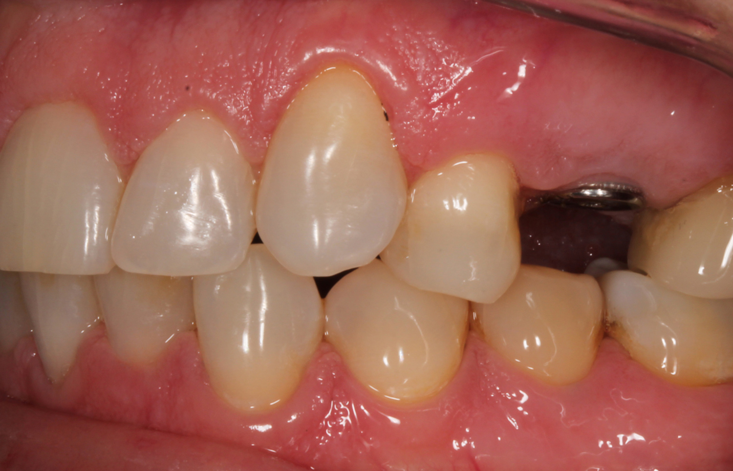 before and after of patient mouth, Shawnee, OK