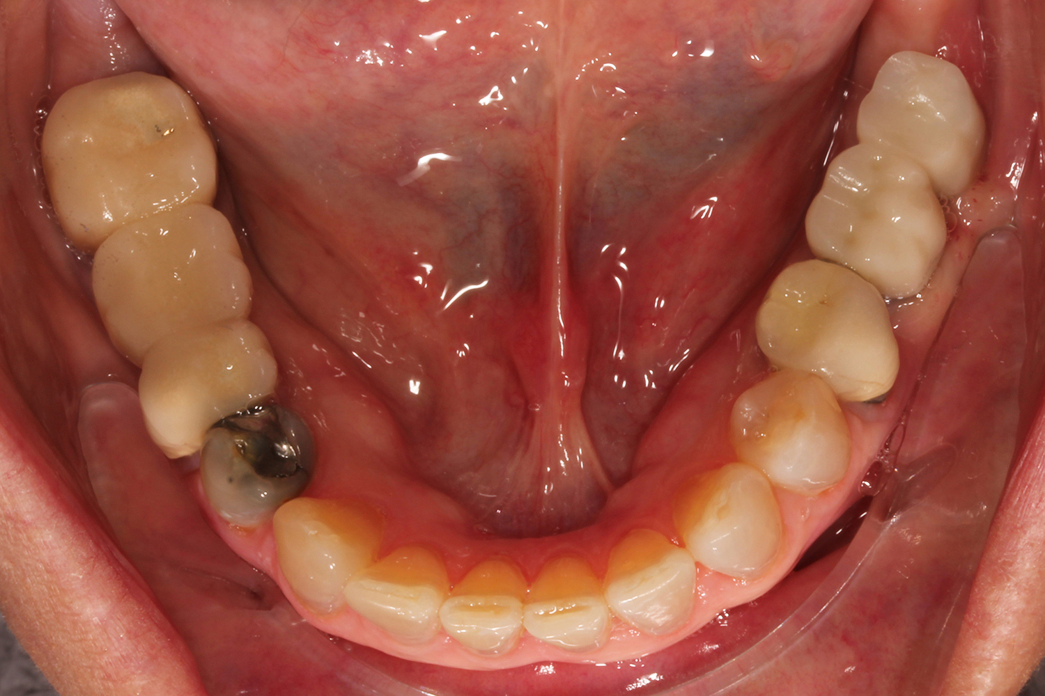 before and after of patient mouth, Shawnee, OK