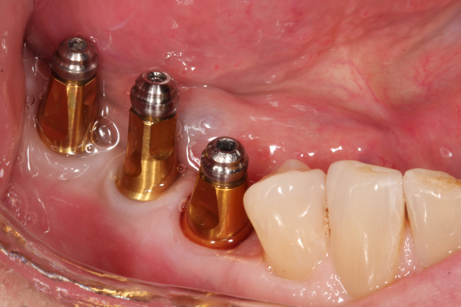 before dental implant bridge, Shawnee, OK