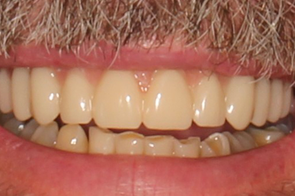 TeethXpress - Case 6 - After