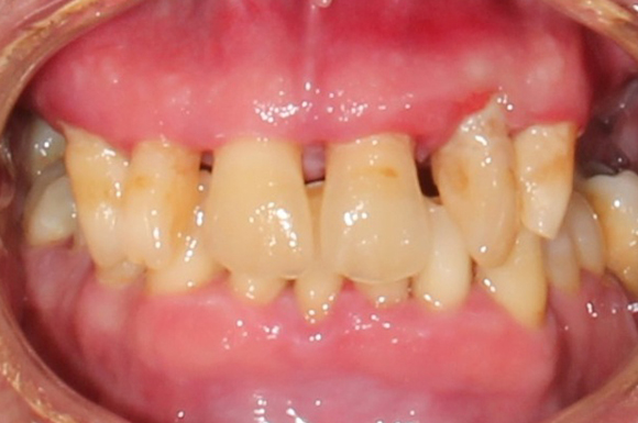 TeethXpress - Case 6 - Before